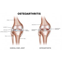 Arthritis/Osteoarthritis