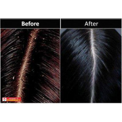 Selsun Blue Replenishing Anti Dandruff Shampoo 200ml